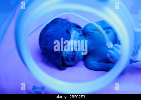 A premature baby in an incubator under phototherapy to treat jaundice. Jaundice is caused by the deposition of excess pigment (bilirubin) in the skin Stock Photo