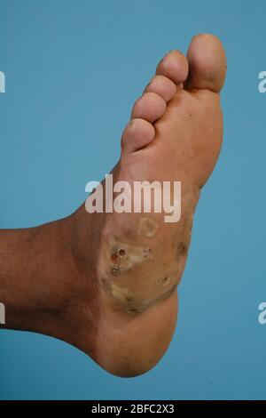 Close up of the foot of a mycetoma sufferer.  Mycetoma is an uncommon disease found in the tropics. It is a chronic, localised infection of the skin a Stock Photo