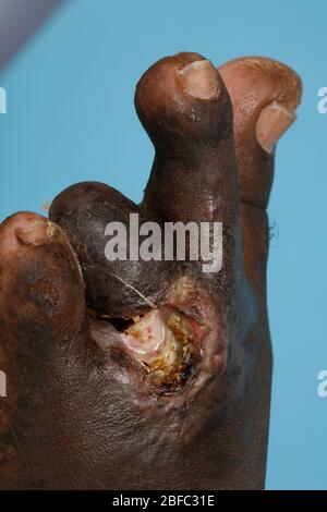 Close up of the foot of a mycetoma sufferer. Note that one toe has been previously amputated in order to prevent the disease from spreading  Mycetoma Stock Photo