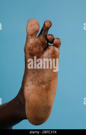 Close up of the foot of a mycetoma sufferer. Note that one toe has been previously amputated in order to prevent the disease from spreading  Mycetoma Stock Photo