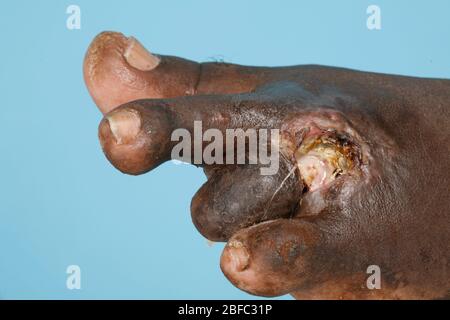 Close up of the foot of a mycetoma sufferer. Note that one toe has been previously amputated in order to prevent the disease from spreading  Mycetoma Stock Photo