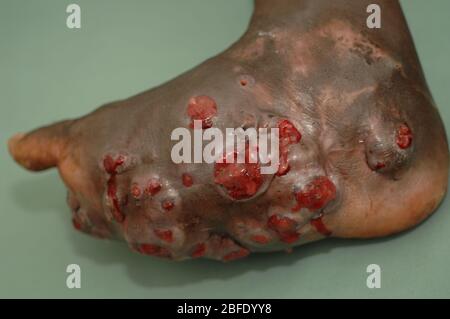 Close up of the foot of a mycetoma sufferer.  Mycetoma is an uncommon disease found in the tropics. It is a chronic, localised infection of the skin a Stock Photo