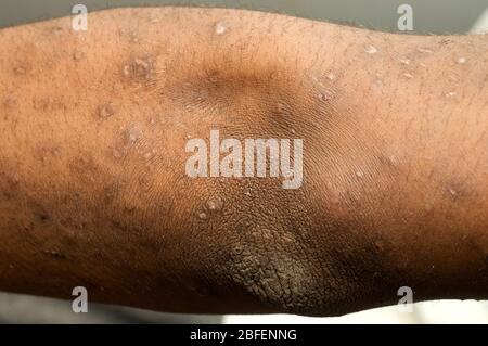 The arm of a patient with mild psoriasis Psoriasis is a common, chronic relapsing/remitting immune-mediated skin disease characterized by red, scaly p Stock Photo