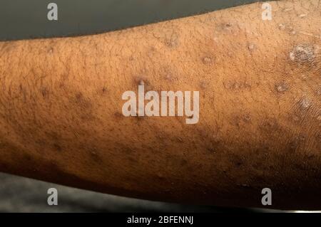 The arm of a patient with mild psoriasis Psoriasis is a common, chronic relapsing/remitting immune-mediated skin disease characterized by red, scaly p Stock Photo