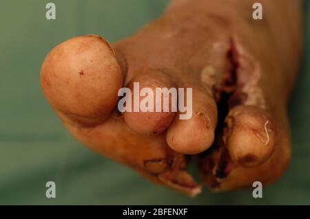 Gangrene left foot Stock Photo - Alamy