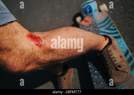 Scar on the Leg, after Injury. the Last Stage of Wound Healing, Scarring  Stock Image - Image of health, help: 192692833