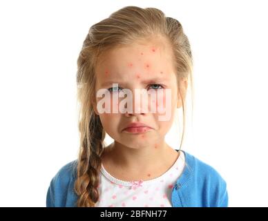 Little girl with red pimples on white background. Chicken pox concept Stock Photo