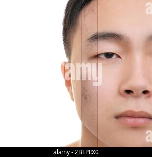 Teen guy with acne problem before and after treatment on light ...