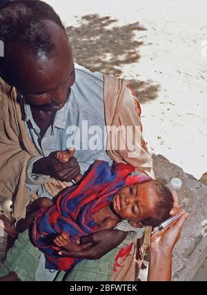 1993 - A Somali refugee child cries after being given water through a syringe at an aid station set up during Operation Restore hope relief efforts. (Bardera Somalia)