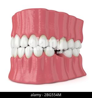 3d Render Of Jaw With Protruding Tooth Revealing Root. Consequences Of 