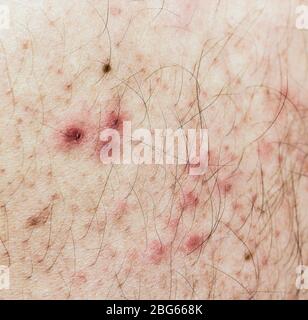 Early stages of rash of varicella-zoster virus in an older caucasian male. Stock Photo