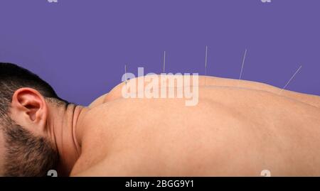 Man getting acupuncture treatment. Acupuncture needles close up on violet background Stock Photo