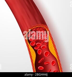 Blocked blood vessel, artery with cholesterol thrombus. 3d vein with clot vector illustration. Medical artery blood, cholesterol disease, blocked flow circulation Stock Vector