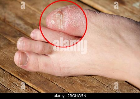 Blisters on the feet Burns, skin abrasions, Scabs Are Dry Stock Photo