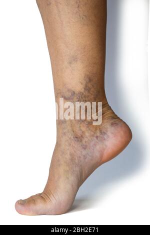 Varicose veins on a female legs. Phlebology problem. Woman's health. Stock Photo