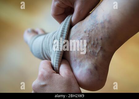 a woman puts a compression stocking on her leg with varicose veins. Varicose  veins prevention, Compression tights, relief for tired legs. Beautiful lo  Stock Photo - Alamy