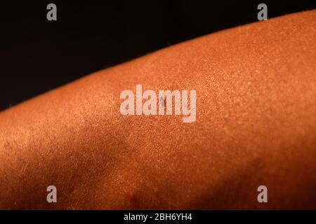 Bee sting. Bee sting in human skin. The consequences of stinging with bee venom. Stock Photo