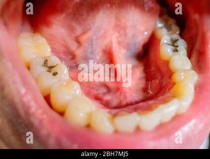 The Sublingual Gland stone disease in mouth Stock Photo