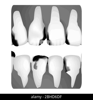 Dental caries. X-ray of tooth decay. Caries infographics. Vector illustration on isolated background. Stock Vector
