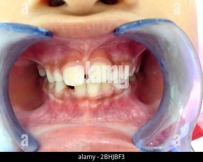 Photo of A Thai boy with Diastemas teeth problem onthe dental unit waitng to see the dentist in Hua Hin, Thailand April 1, 2018 Stock Photo