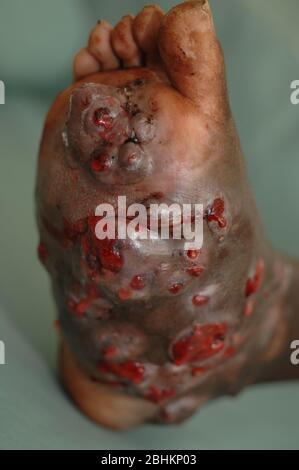 Close up of the foot of a mycetoma sufferer.  Mycetoma is an uncommon disease found in the tropics. It is a chronic, localised infection of the skin a Stock Photo