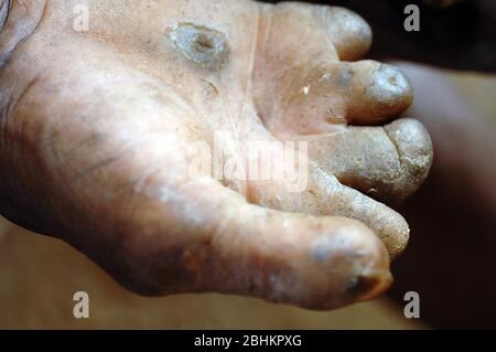 The mutilated hands of an elderly man suffering from leprosy. Leprosy (Hansen’s disease) is a chronic infectious disease caused by Mycobacterium lepra Stock Photo