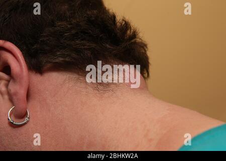 Sebaceous cyst Stock Photo - Alamy