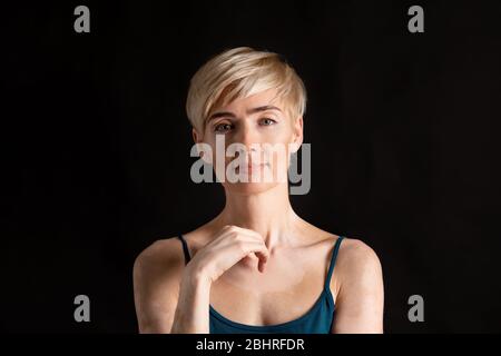 Unusual beauty concept. Vitiligo affected woman, in studio Stock Photo