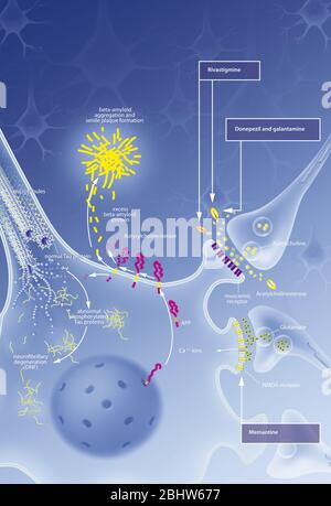 Neuron with neurofibrillary degeneration process, senile plaque ...