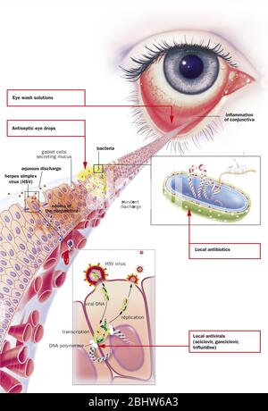 Infectious conjunctivitis and its treatments. View of an eye with ...