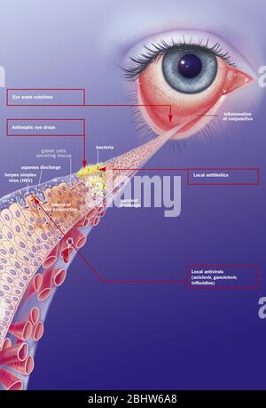 Infectious conjunctivitis and its treatments. View of an eye with ...