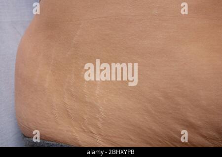 Postnatal changes as stretches on skin. After birth marks on belly of woman. Close-up view of postpartum stretches or age skin recovery Stock Photo