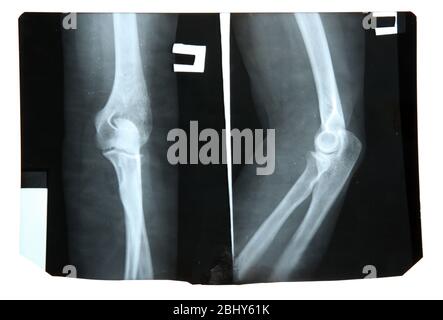 X-ray of human knees, closeup Stock Photo