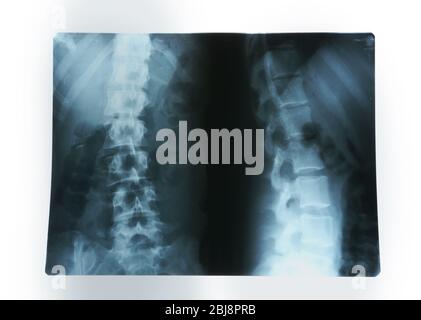 X-ray of human spinal column isolated on white Stock Photo