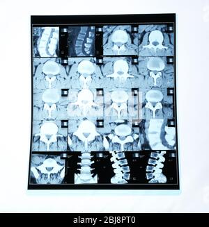 Collage of x-rays isolated on white Stock Photo