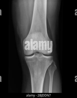 X-ray knee radiograph show state of injury Stock Photo