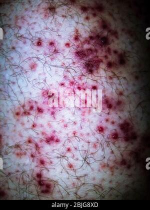 Shingles Herpes Zoster Stock Photo