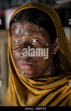Acid attack survivor in Bangladesh Stock Photo