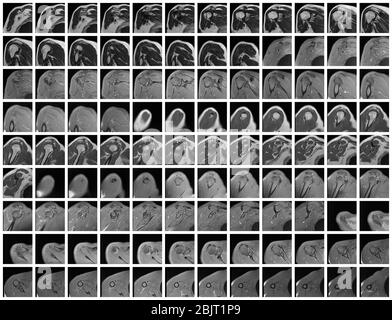 Magnetic Resonance Imaging or MRI of Shoulder Joint Coronal T2 FS and ...