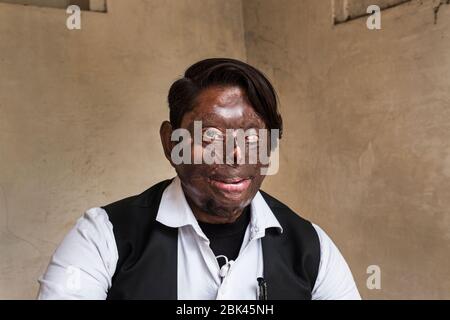 Acid attack survivor, India Stock Photo