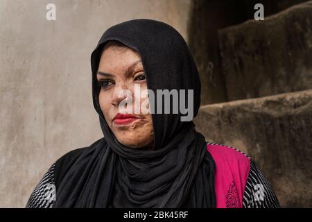 Acid attack survivor, India Stock Photo