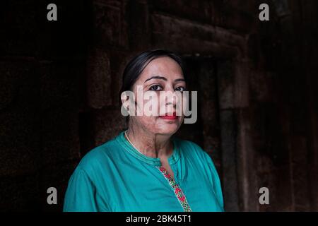 Acid attack survivor, India Stock Photo