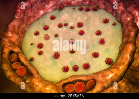 Human alveoli filled with fluid and SARS-CoV-2 viruses during COVID-19 infection, conceptual computer illustration. Stock Photo
