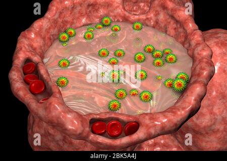 Human alveoli filled with fluid and SARS-CoV-2 viruses during COVID-19 infection, conceptual computer illustration. Stock Photo