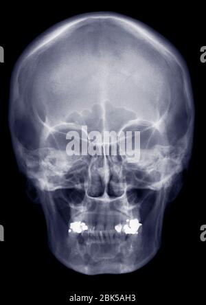 Human skull from front, X-ray. Stock Photo