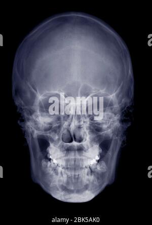 Human skull from front, X-ray. Stock Photo