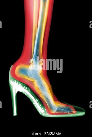 Leg in stiletto shoe, coloured MRI style X-ray. Stock Photo