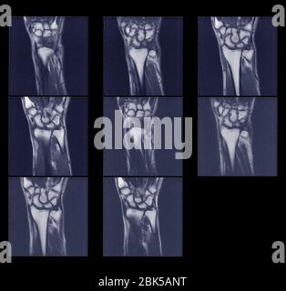 Multiple scans of wrist, MRI. Stock Photo
