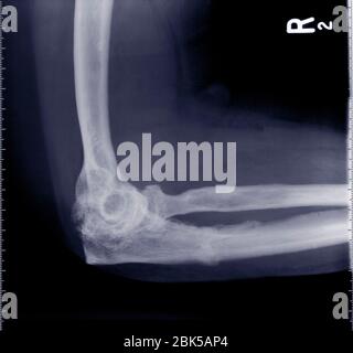 Elbow from side, X-ray. Stock Photo
