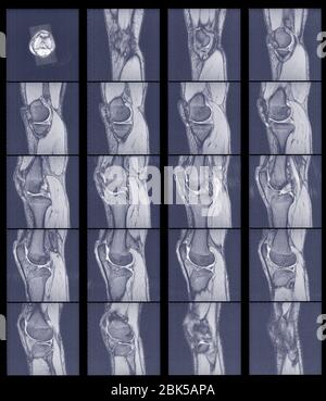 Multiple scans of knee joint, MRI. Stock Photo